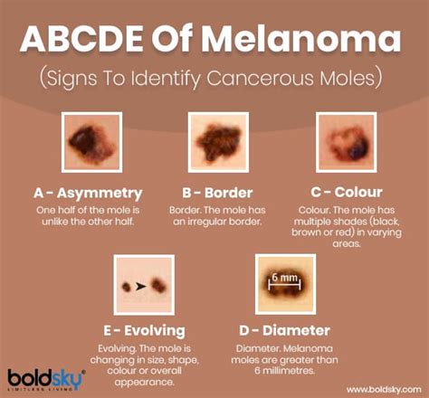 Types of Moles with Pictures, Causes, and Treatments